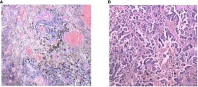 Primary cervical malignant melanoma that was successfully treated with pembrolizumab: a case report and literature review